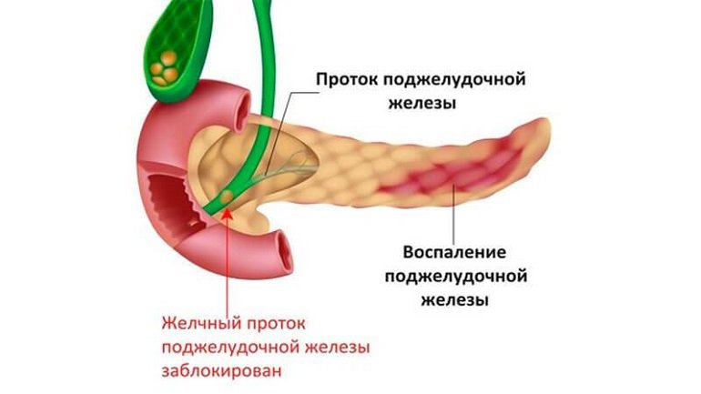 Часник при панкреатиті: вплив на підшлункову залозу і правила вживання