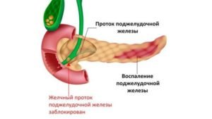 Причини і ознаки панкреатиту у чоловіків