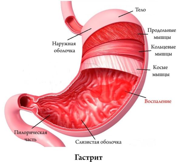 Чим зняти біль в шлунку при гастриті