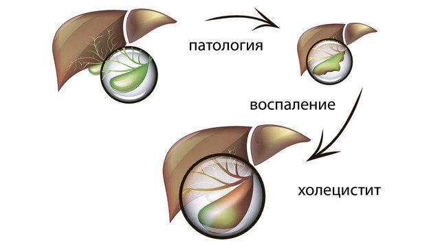 Препарати, народні засоби і дієта при лікуванні холециститу