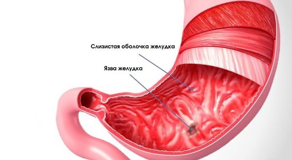 Ознаки, симптоми і лікування гастриту з підвищеною кислотністю