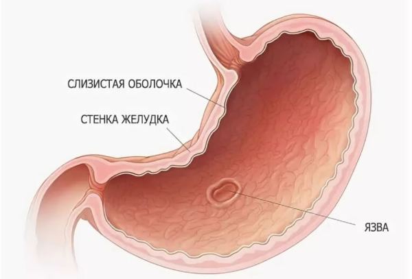 Чи можна пити кефір при виразці шлунка і дванадцятипалої кишки?