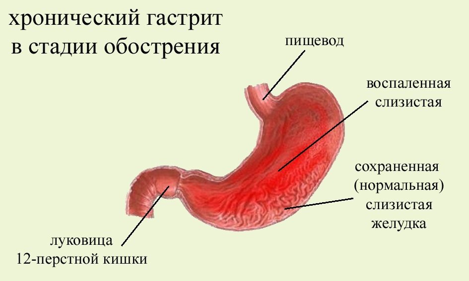 Молоко і молочні продукти при гастриті