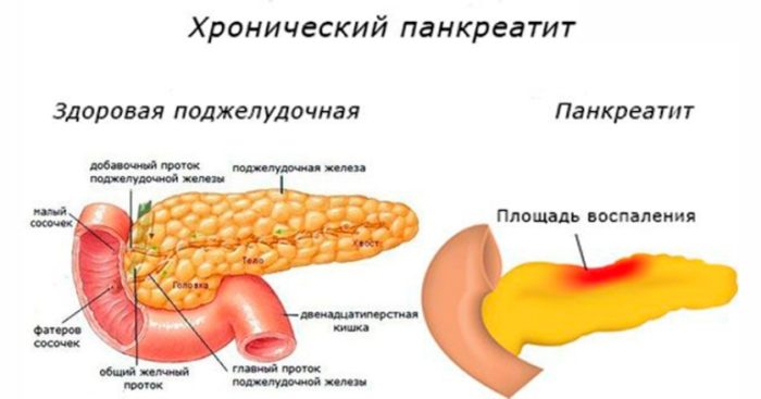 Що можна їсти при панкреатиті підшлункової залози?