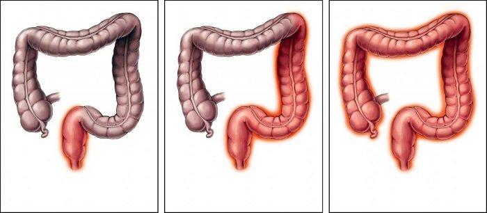 Причини, лікування і профілактика дифузного коліту