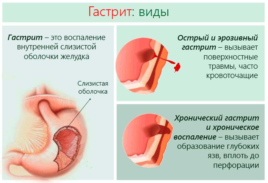 Хронічний антральний гастрит - що це таке?