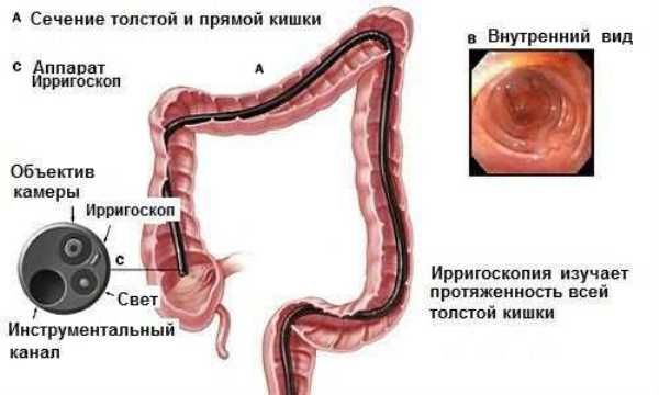 Ішемічний коліт кишечника