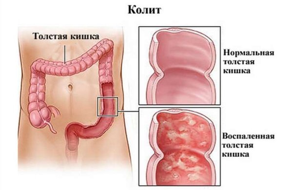 Атонічний коліт кишечника - причини і профілактика