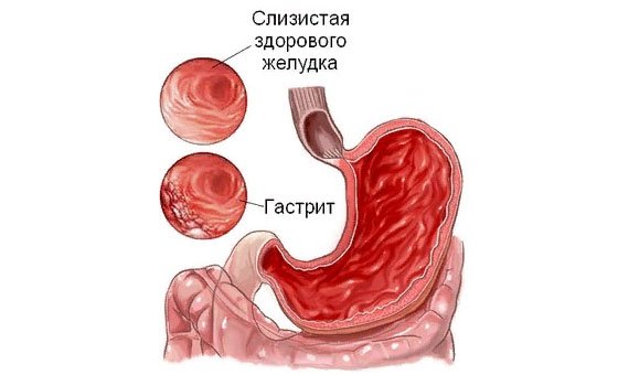 Температура при гастриті