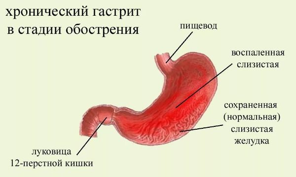 Температура при гастриті