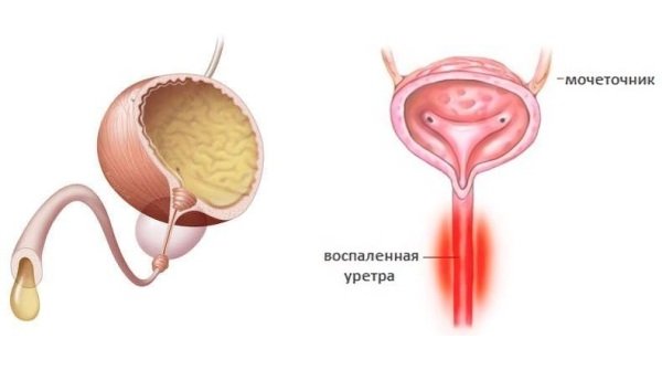 Хвороби сечового міхура у жінок - ознаки, лікування і профілактика