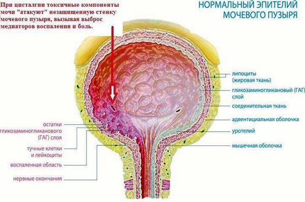 Хвороби сечового міхура у жінок - ознаки, лікування і профілактика