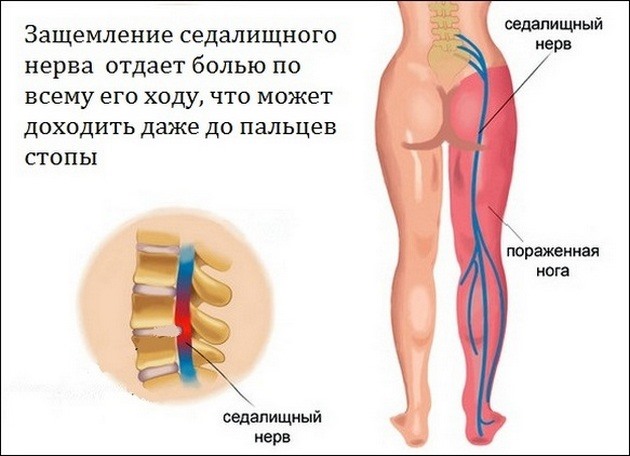 Защемлення нерва в тазостегновому суглобі