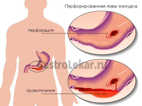 Що робити якщо турбує гострий біль у шлунку