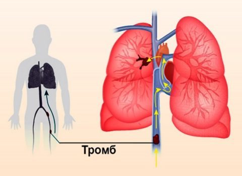 Легенева емболія: що це таке, і як лікувати