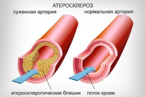 Низький рівень тестостерону у чоловіків