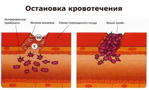 Чим небезпечна постгеморрагическая анемія, і як її лікувати