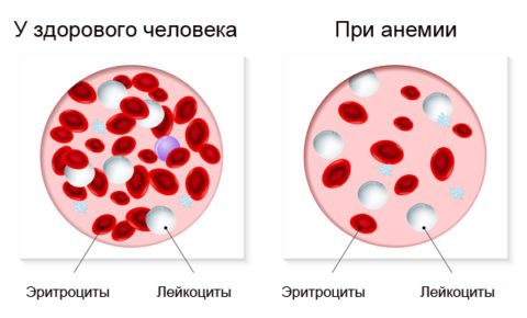 Що таке цитопения, і як її лікувати?